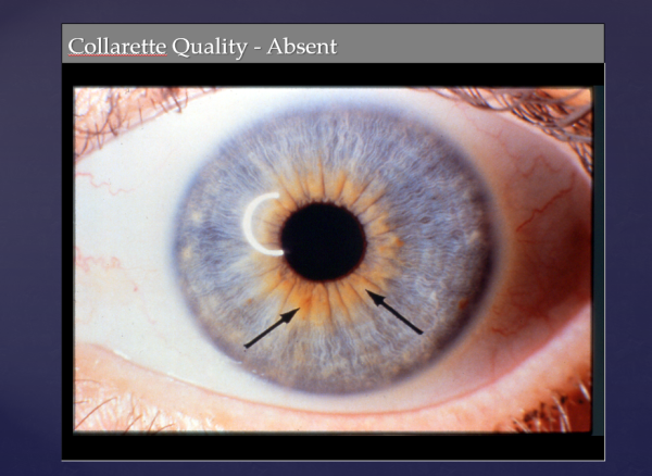 Collarette Quality - Absent Collarette Signs ~ CD-ROM PPP