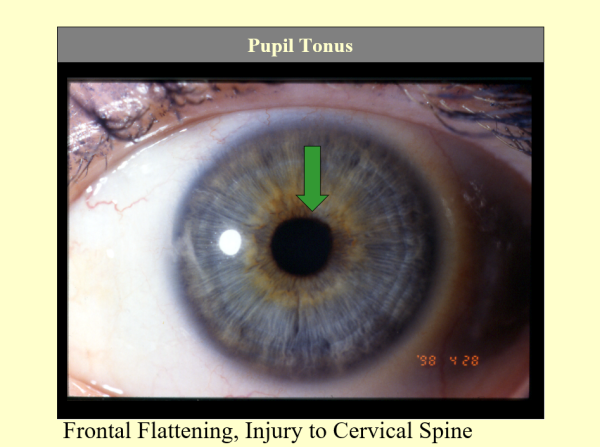 Frontal Flattening, Injury to Cervical Spine Pupil Tonus ~ CD-ROM PPP