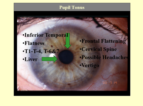 Inferior Temporal Pupil Tonus ~ CD-ROM PPP