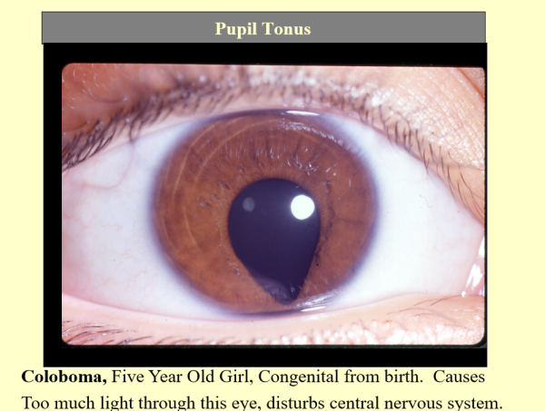 Pupil Tonus ~ CD-ROM PPP