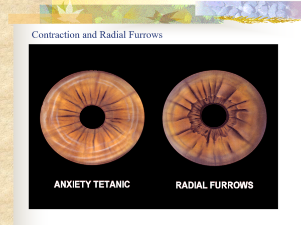 Contractions and Radial Furrows - Contraction Furrows, Sclera Signs, and Syndromes ~ CD-