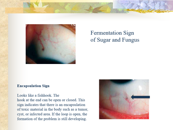 Fermentations Signs of sugar and Fungus Contraction Furrows, Sclera Signs, and Syndromes ~ CD-ROM PPP